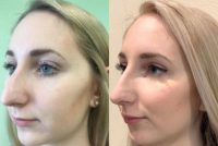 18-24 year old woman treated with Injectable Fillers