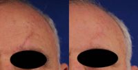 55-64 year old man treated with Scars Treatment