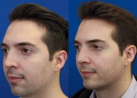 25-34 year old man treated with Revision Rhinoplasty and Chin Implant.