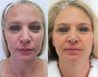 42 year old woman treated with Injectable Fillers