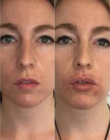 Woman Treated with Lip Augmentation Using Juvederm
