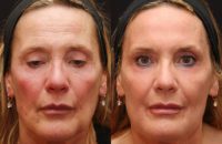 Fraxel Repair for Sun Damage and Wrinkles