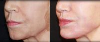 Woman treated with Restylane