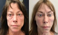 Woman treated with Sculptra Aesthetic