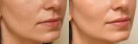 Lip Augmentation with Restylane Silk