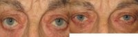 Lower Eyelid Retraction Repair