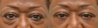 Lower Blepharoplasty and Lateral Canthopexy