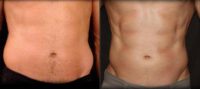 Man treated with CoolSculpting