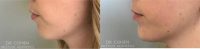 Woman treated with Chin Filler