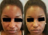Woman treated with Vampire Facelift