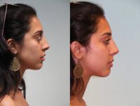 Woman treated with Non Surgical Nose Job
