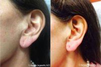 Non-Surgical Earlobe Repair with Restylane