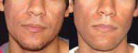 Photodynamic Therapy for Severe Acne