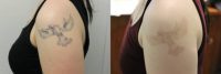 PicoSure Laser Tattoo Removal after THREE treatments