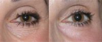 Reducing Lower Lid Fine Lines with CO2 Laser Resurfacing