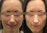 Restylane and Dysport to the Glabella
