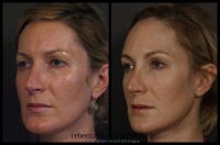Sculptra for Volume and Contouring