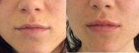 Woman treated with Lip Augmentation Using Juvederm