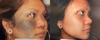 Woman treated with Pulsed Dye Laser