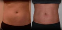 Treated with CoolSculpting