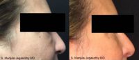 Undereye Fat Pads Reduced With Kybella