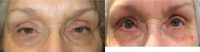 Upper Eyelid Ptosis Repair