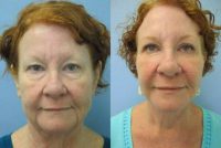 Woman, facelift and BOTOX procedure