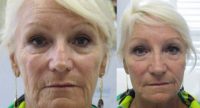 Wrinkle treatment for woman for lower face