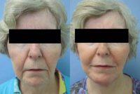 Wrinkle treatment on woman's lip, jaw and cheek areas