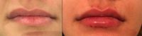 25-34 year old woman treated with Lip Augmentation with my nanodroplet technique