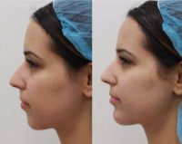 29 year old female treated with Voluma for chin augmentation