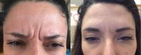 25-34 year old woman treated with Botox
