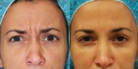 41 year old female treated with Botox for frown lines