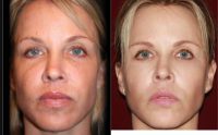 45-54 year old woman treated with Sculptra