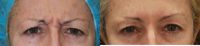 48 year old woman treated with Botox for frown lines/glabellar lines