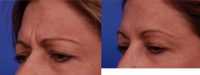 45-54 year old woman treated with Botox, Treatment areas include; Glabella