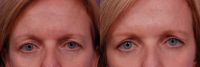 Botox 44-54 year old Female  - treatment areas include: glabella, and crows feet