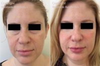 Non Surgical Under Eyes and Voluma Cheeks
