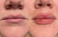 23 year old lady with Lip Augmentation