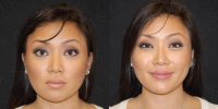 25-34 year old woman treated with Nonsurgical Facelift
