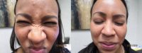 31 year old woman treated with Botox