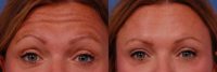 35-44 year old woman treated with Botox in the glabella, crows feet, and forehead areas.