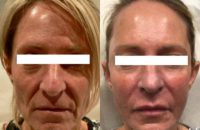 45-54 year old woman treated with Sculptra Aesthetic