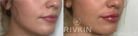 Lip Augmentation with Vollure
