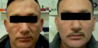 45-54 year old man treated with Sculptra Aesthetic