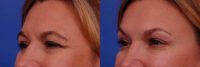 45-54 year old woman treated with Botox, Treatment areas include; Glabella, Forehead, and Crows Feet