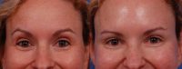 35-44 year old woman treated with Botox in the glabella, crows feet, jelly roll, and forehead areas.