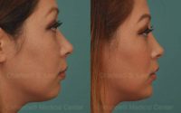Non-Surgical Chin Augmentation & Asian Rhinoplasty Using 2cc of Filler