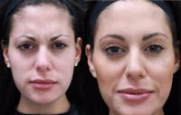 27 year old female treated with Botox for forehead lines, frown lines, and crow's feet