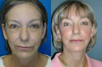 Filler, Botox, and Laser Resurfacing